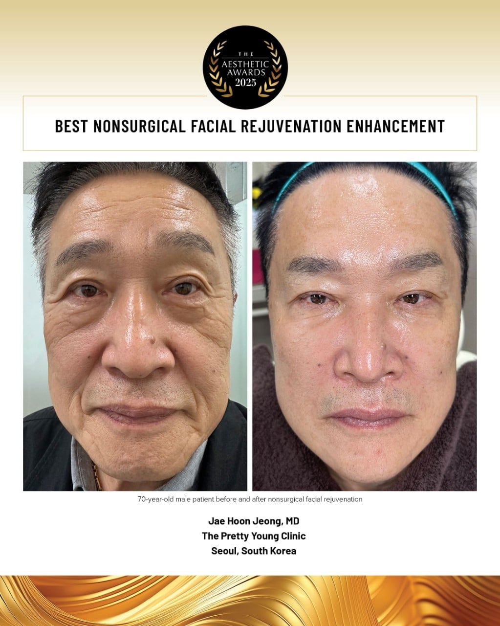 nonsurgical facial